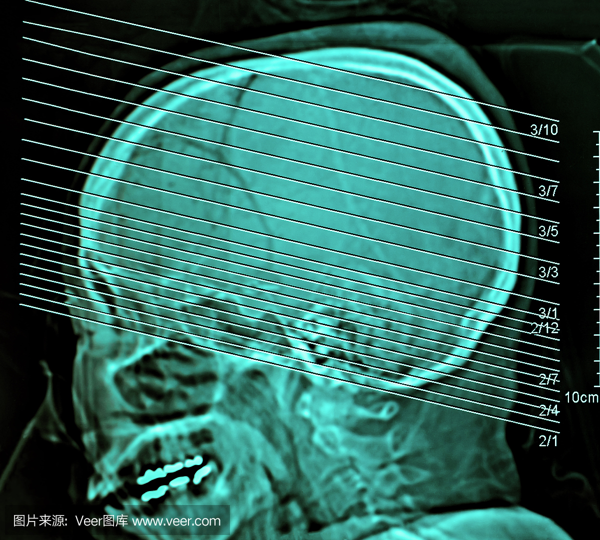 人脑电脑胶片X线断层扫描,CT扫描,医学概念