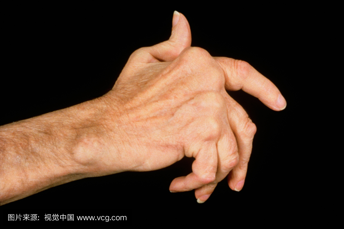 一只手的视图显示关节的变形,与类风湿性关节