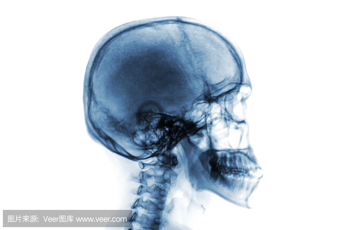 X射线正常颅骨和颈椎。侧视图。反转颜色风格