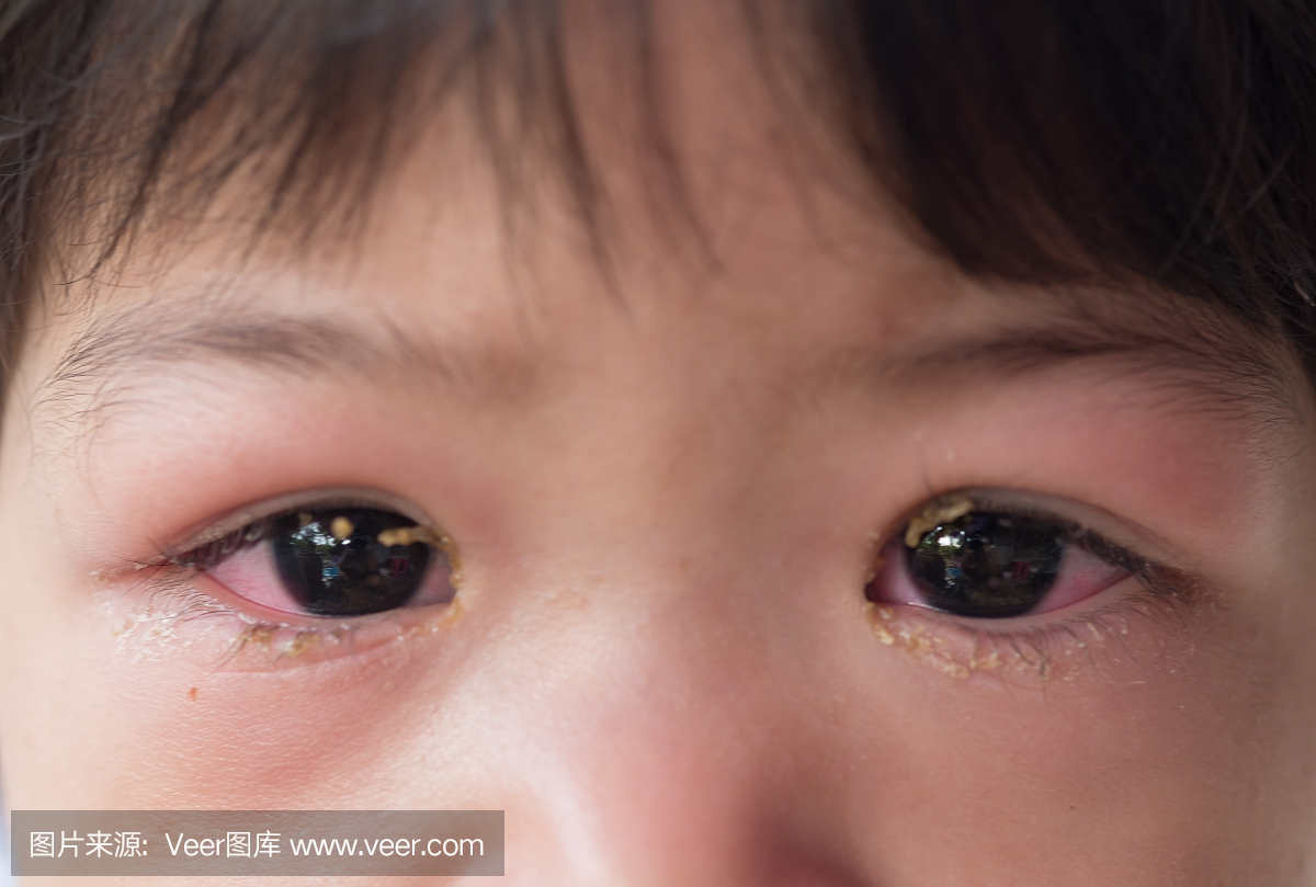 眼睛感染。