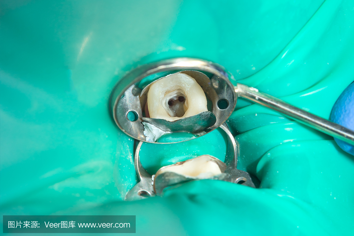牙齿特写的根管治疗。清洁牙齿的根部及其填充