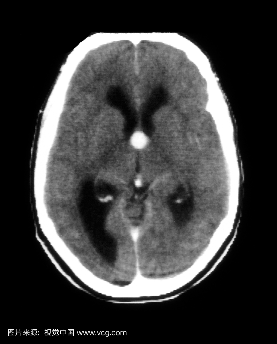 脑的轴向(横截面)CT图像在与脑积水相关的门静