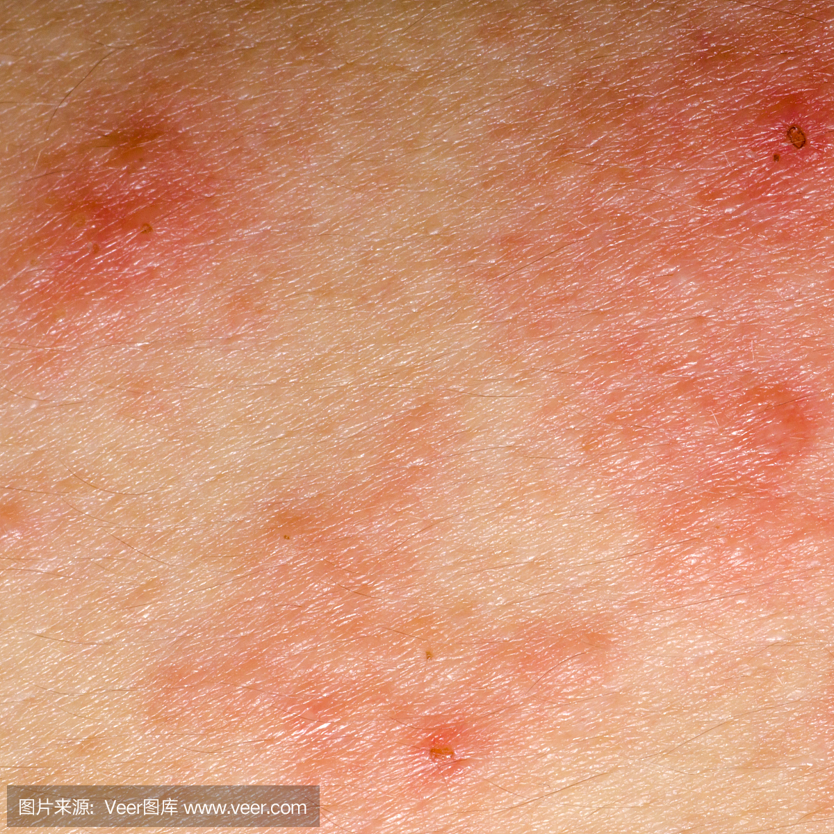 皮肤出现丘疹、红斑、小水泡，还剧烈瘙痒是怎么回事？_患者