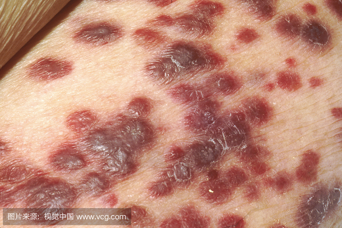 艾滋病患者皮肤上的Kaposis肉瘤。