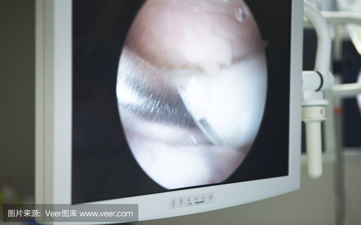 关节镜手术屏幕显示关节镜相机图片在膝关节半