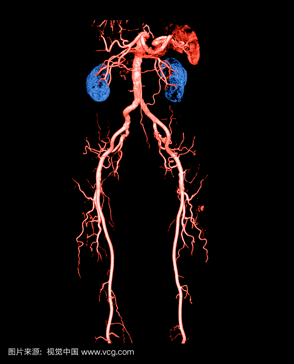 从腹主动脉和腿的CT血管造影图的这个正面视
