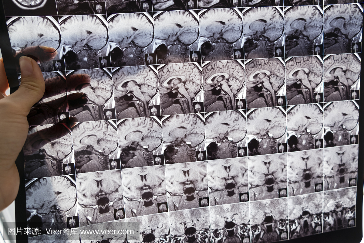 CT扫描和头骨上的特写。健康医学图像的头部