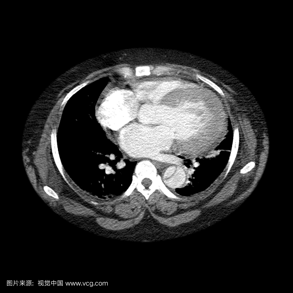 通过胸部的轴向(横截面)CT图像具有静脉对比度