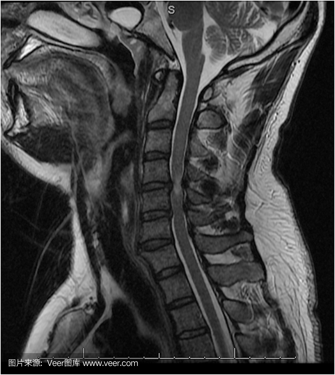 颈椎管狭窄MRI