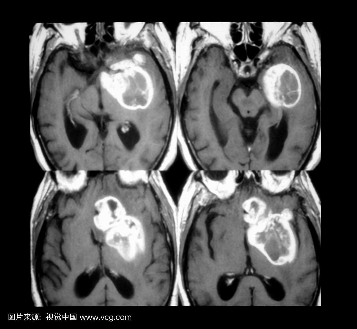四个对比度增强的轴向T1加权MRI图像的复合物