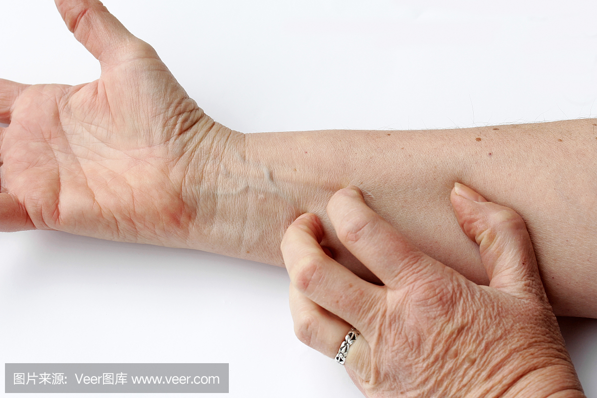 一个女人的手臂内侧有干燥的皮肤发痒