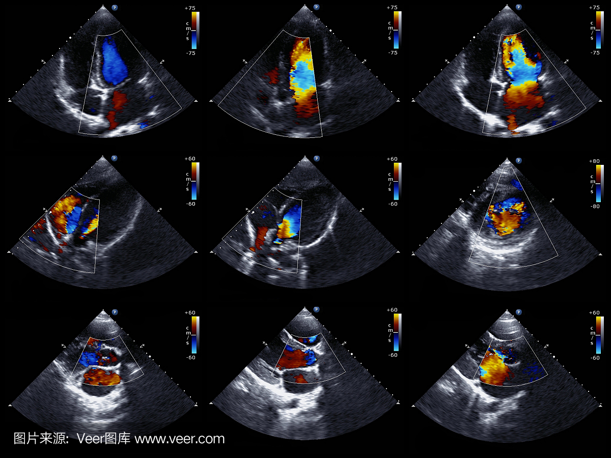 来自多普勒超声心动图的三张图像在3×3格
