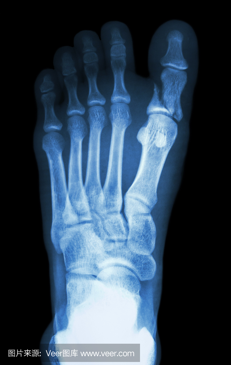 第一趾骨折近端趾骨