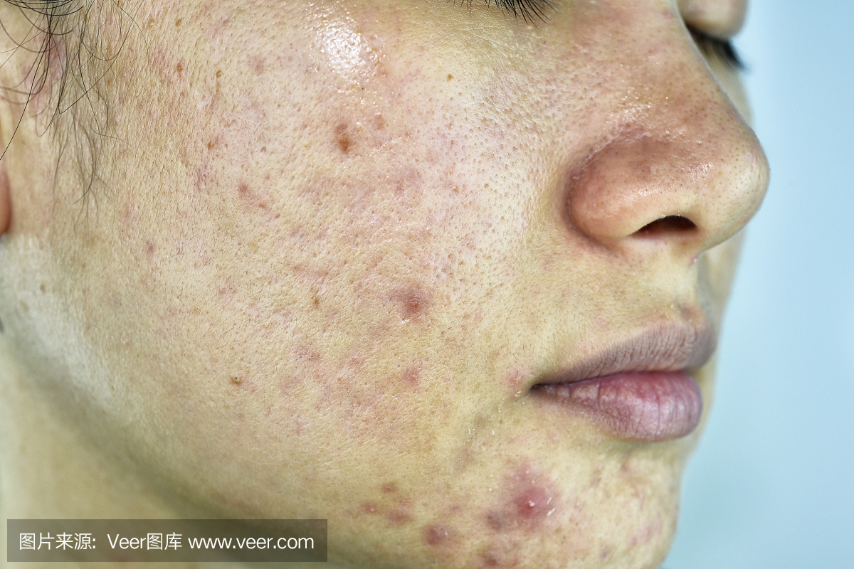 痤疮疾病的皮肤问题,关闭了女人脸与白头粉刺
