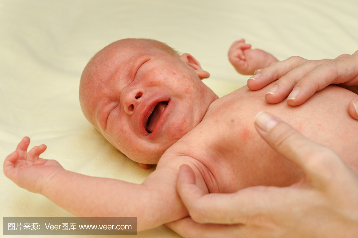 患有过敏性皮疹的生病的新生儿正在哭泣