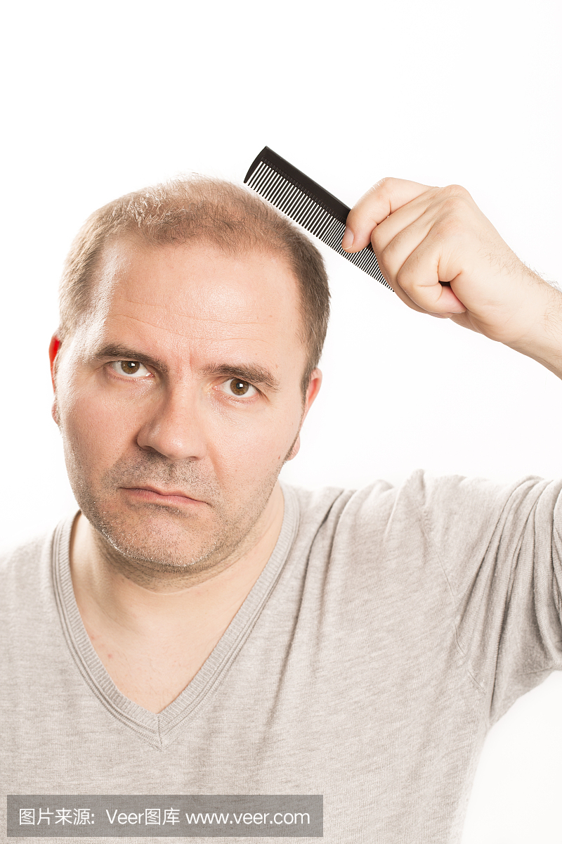 秃头症,发秃,发际线后移,高发际