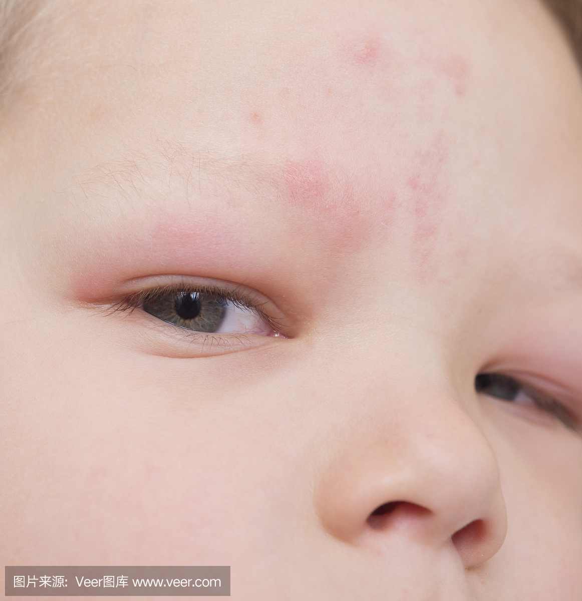 婴儿的手有皮疹和过敏，由蚊子叮咬引起的红斑照片摄影图片_ID:321192567-Veer图库