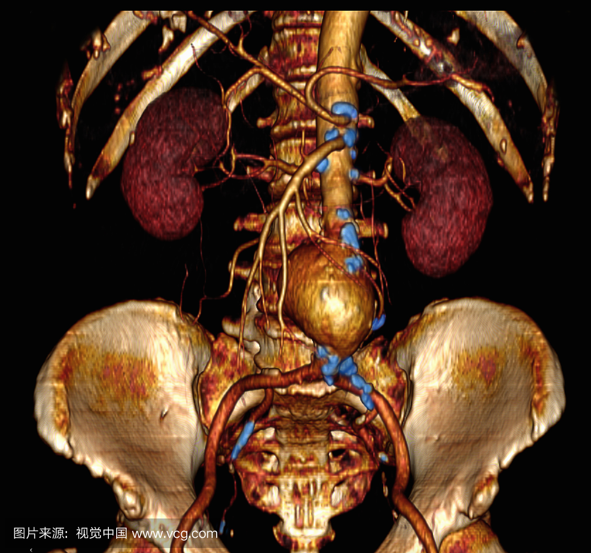 骨盆,骨盘,盂,3D扫描