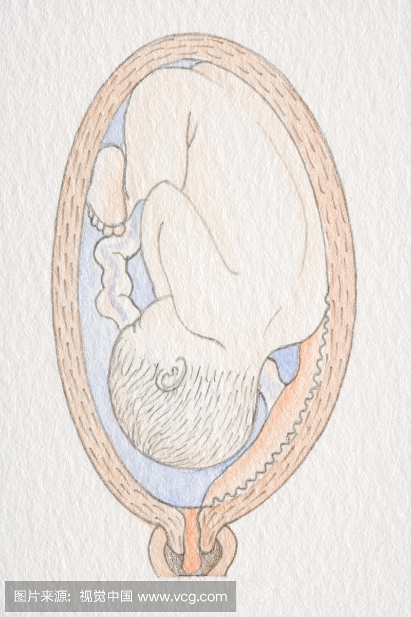 倒置的胎儿在肿胀的子宫内与胎盘接近子宫颈开