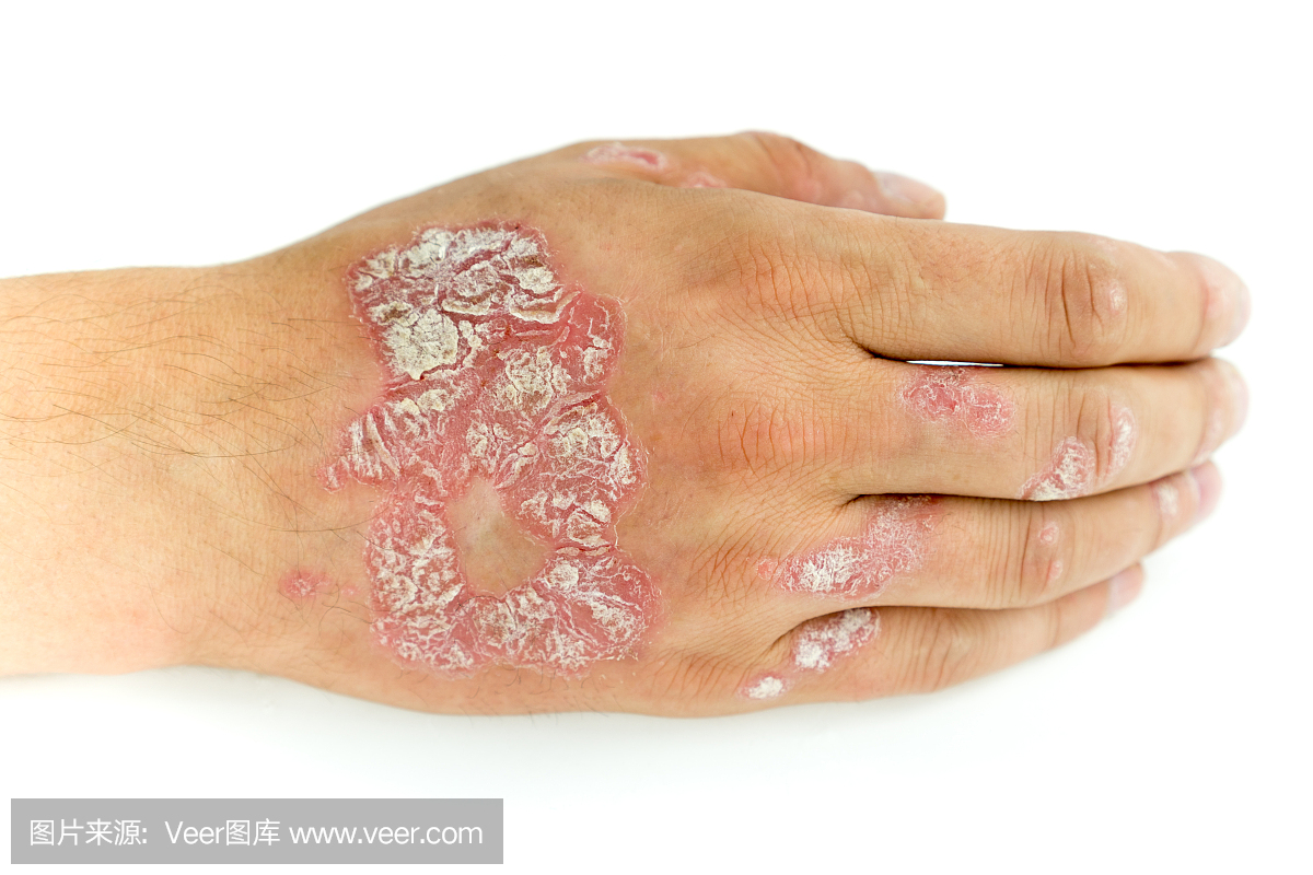 牛皮癣和真菌在男人的手和手指与斑块,皮疹和