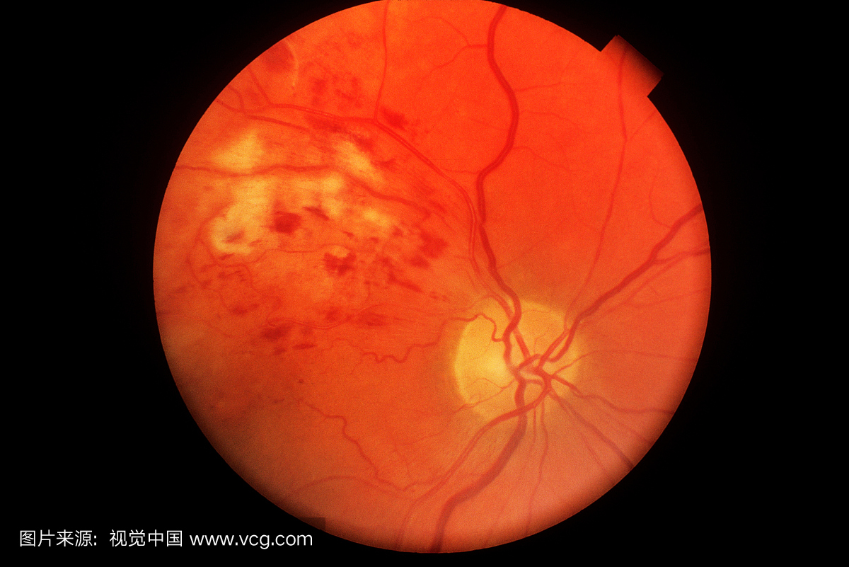 与系统性疾病相关的视网膜病变——1、高血压动脉硬化性眼底改变改变 - 知乎
