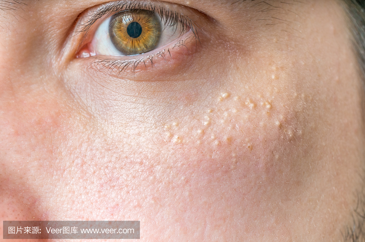 Milia(Milium) - 皮肤周围的眼睛周围的丘疹。