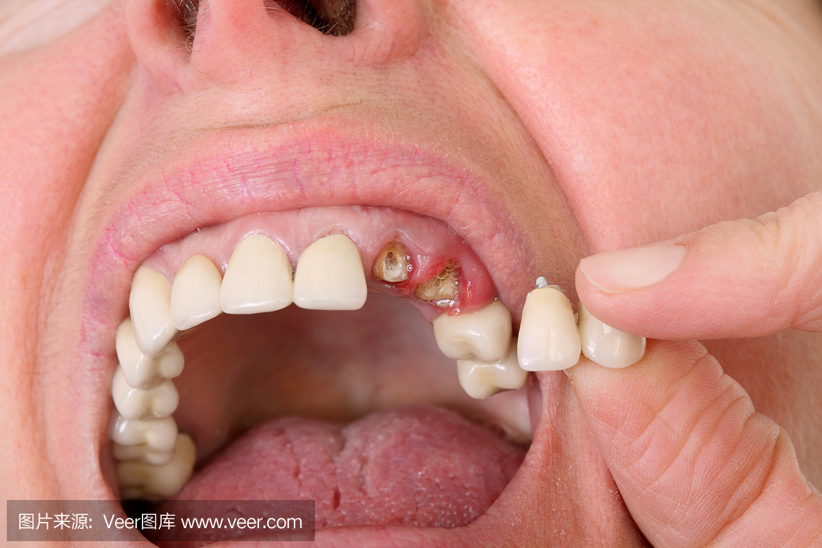 用牙齿修牙牙齿