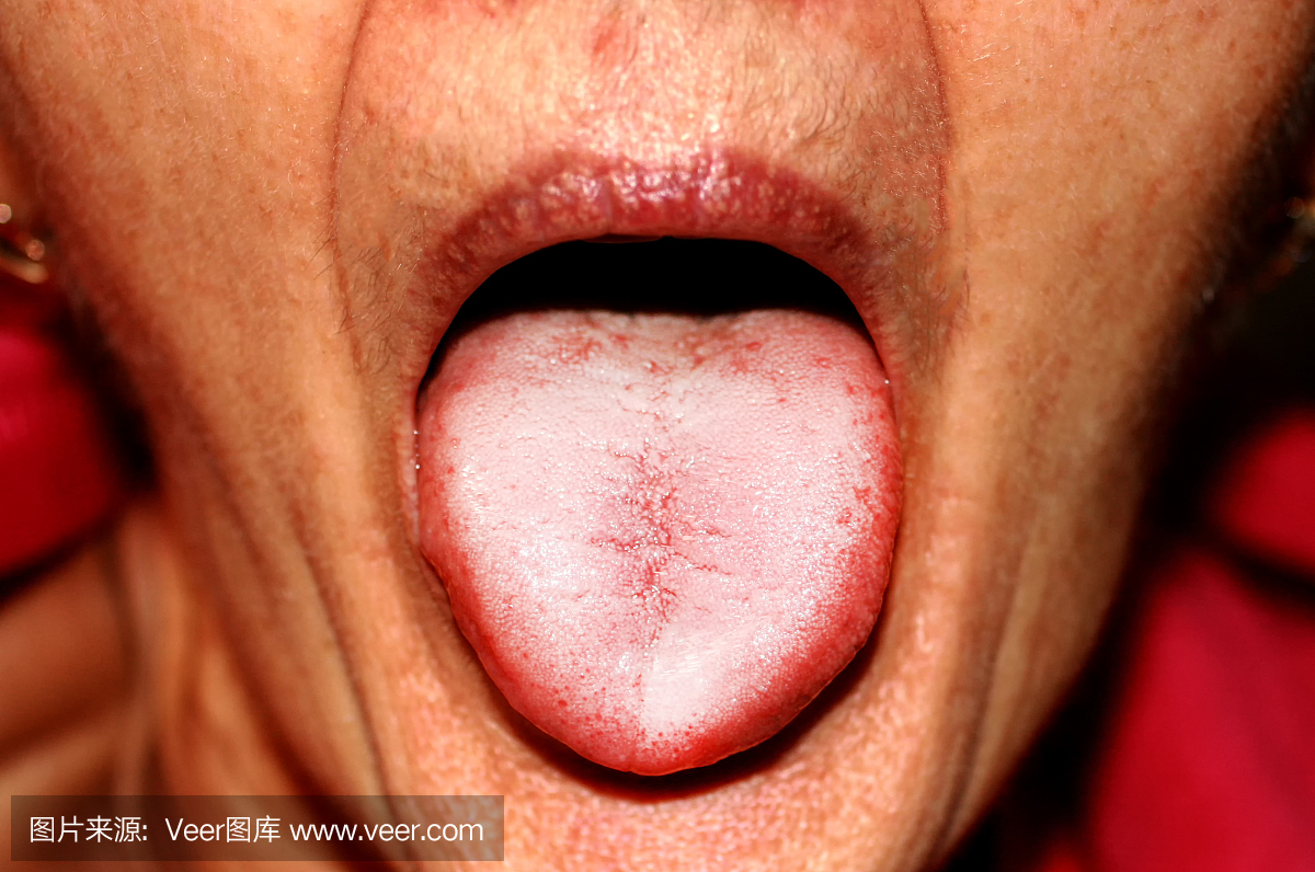 舌头在白色突袭中。舌头念珠菌病