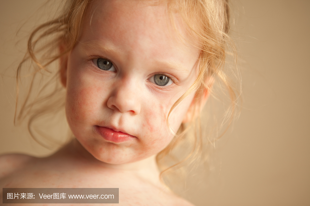 小孩从皮肤过敏反应到抗生素