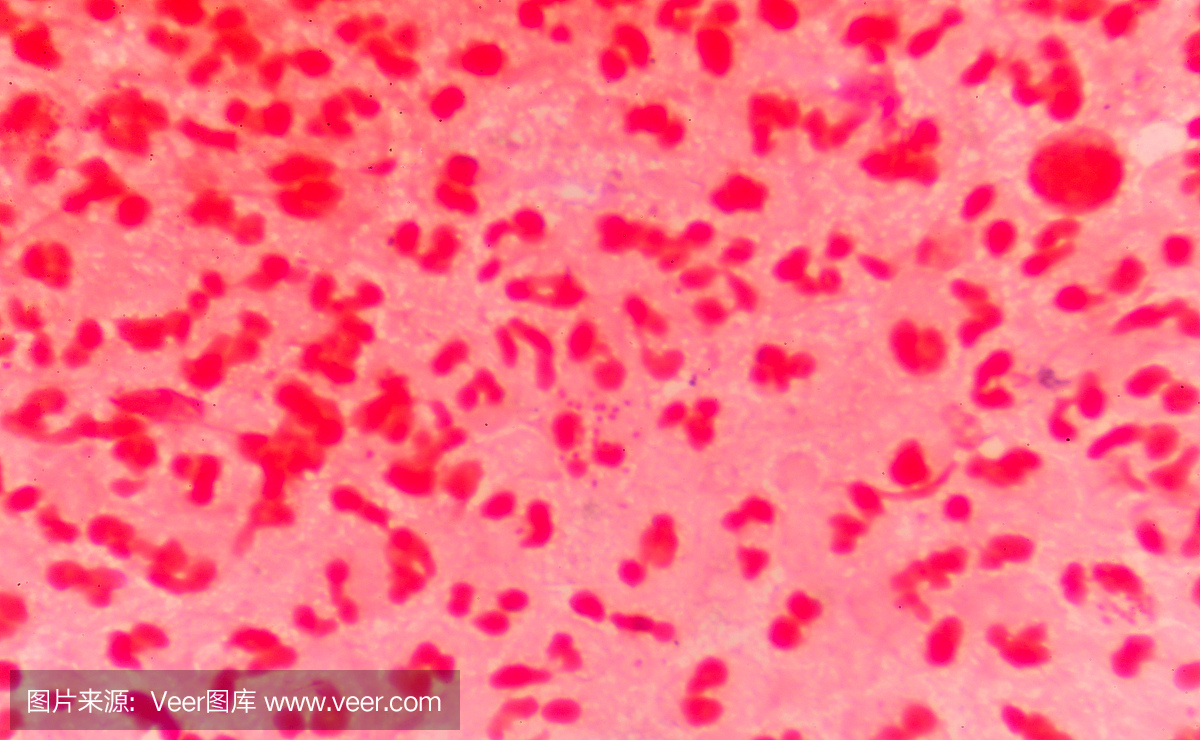 中度红细胞与革兰氏阴性双球菌