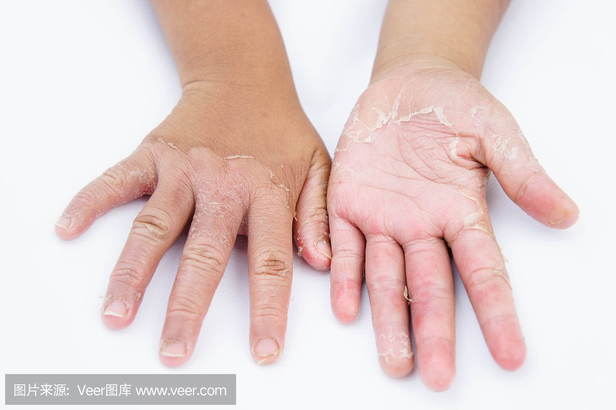 干手,皮,接触性皮炎,真菌感染,皮肤病
