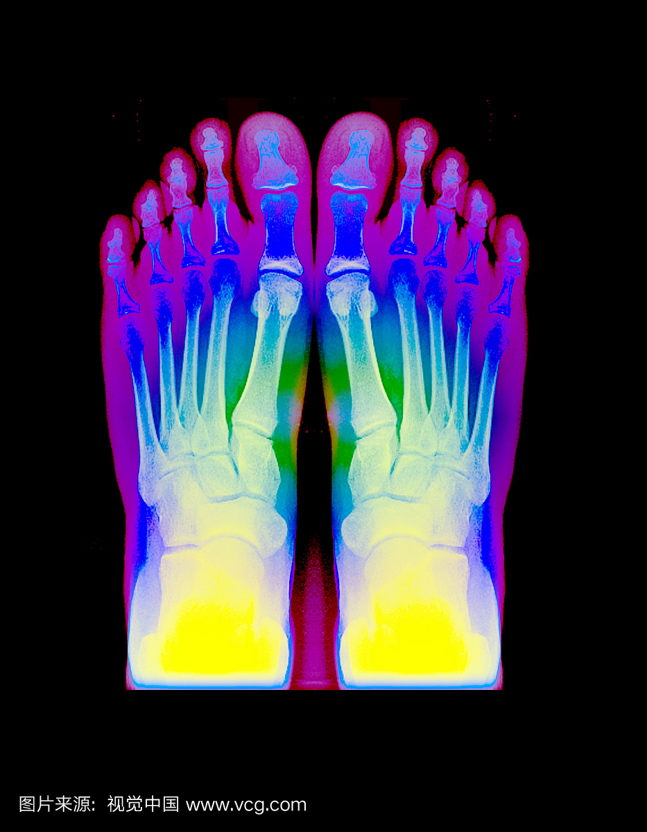 这是脚的正常颜色增强型AP(正面)x射线。脚分