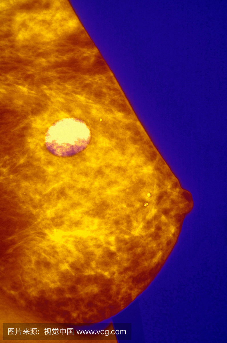彩色增强乳房X线照片显示良性囊肿和钙化; 35