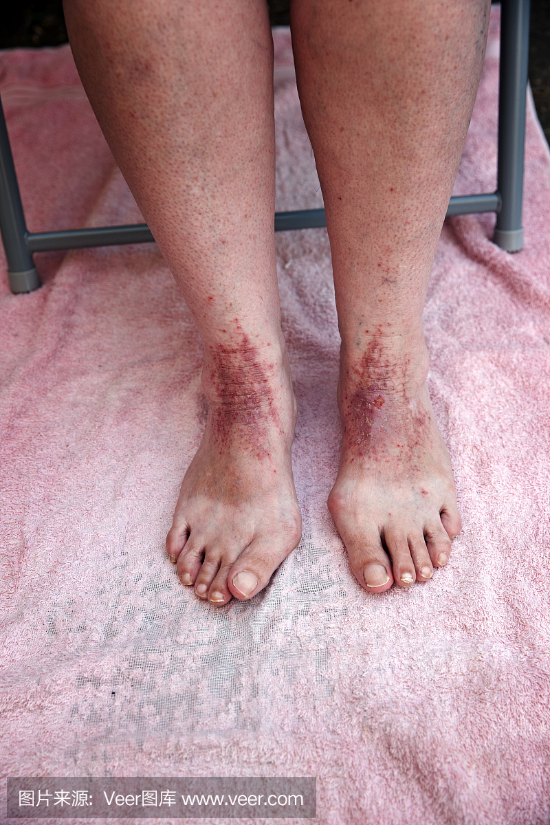 在脚和脚踝上有不良湿疹的成熟女人