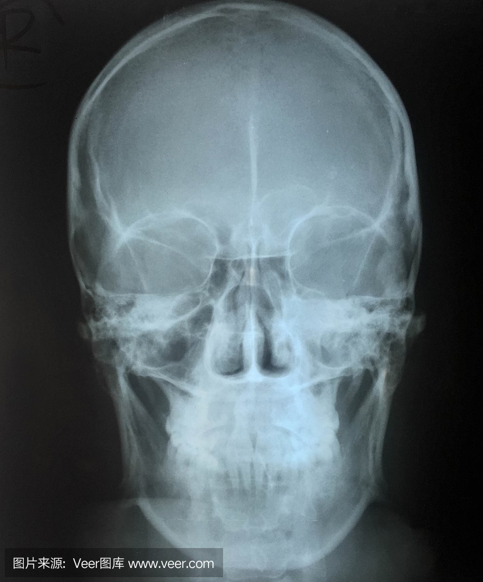 X光片,X片,X射线照片,医院影像
