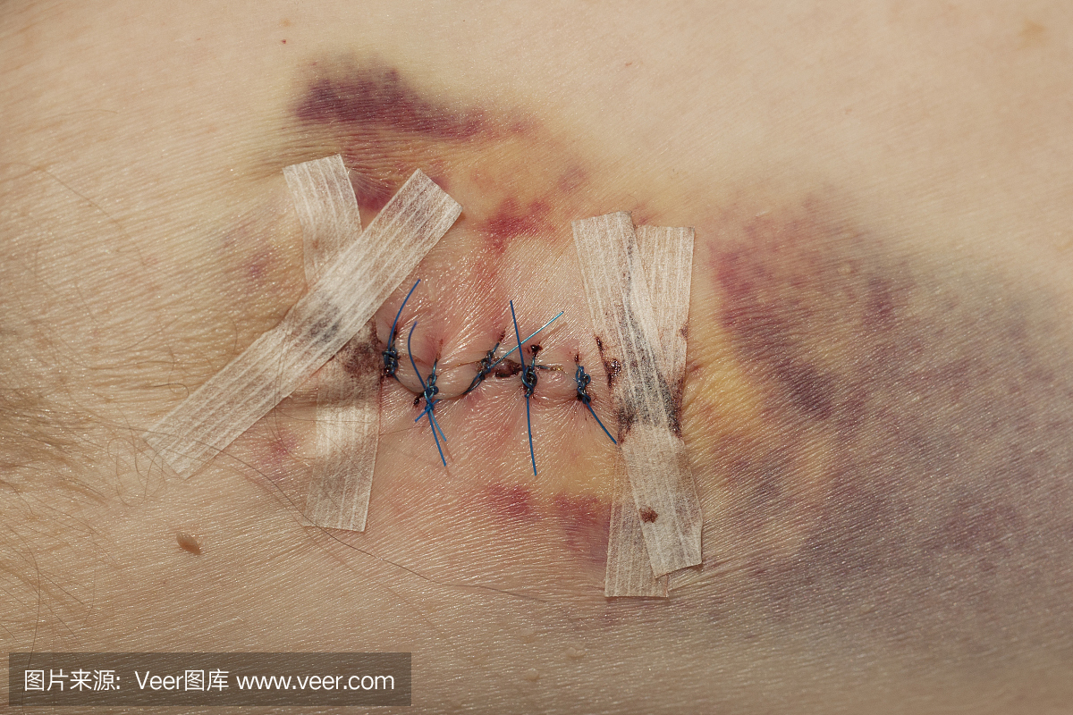 手术切除痣后的伤口缝合线