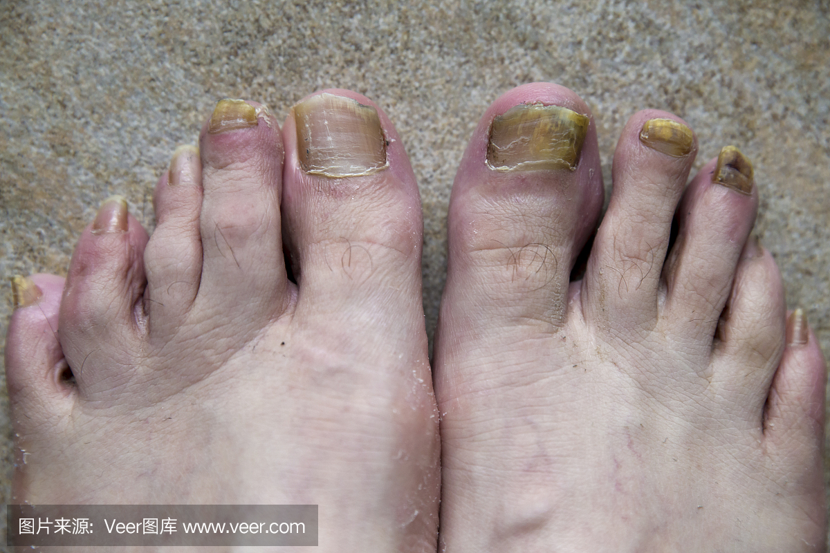 灰指甲真菌感染双足