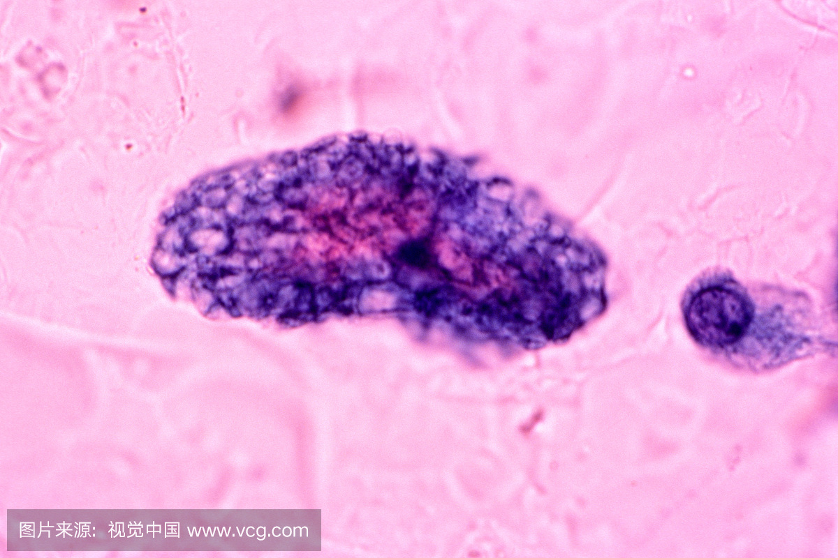 人类痰液中的卡氏肺囊虫显示出特征性蓬松的聚