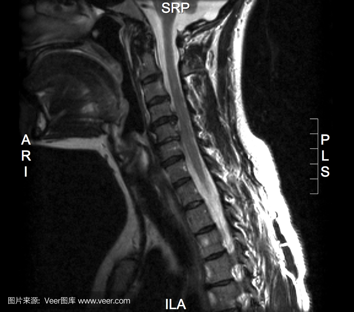 具有标签的C型脊柱的黑白MRI图像