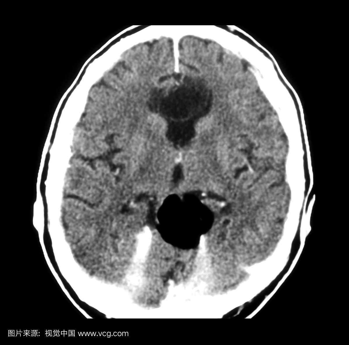 脑的轴向(横截面)CT图像显示2个单独的病变。