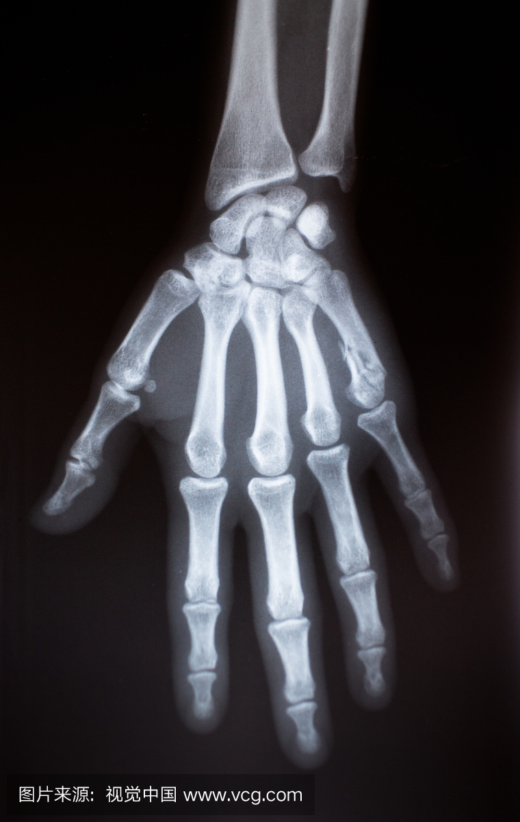 手的X射线