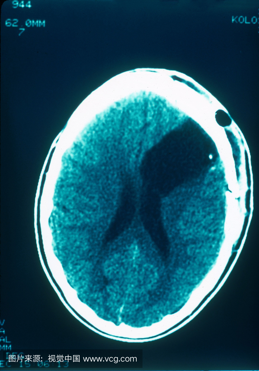 术后CT扫描一名16岁女性的大脑,经过额叶脑神