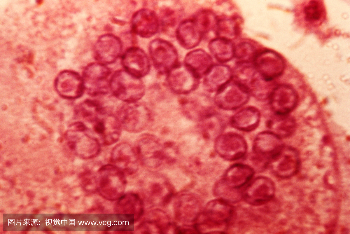 巨细胞肺炎的显微镜像,也称为Hecht的肺炎。这