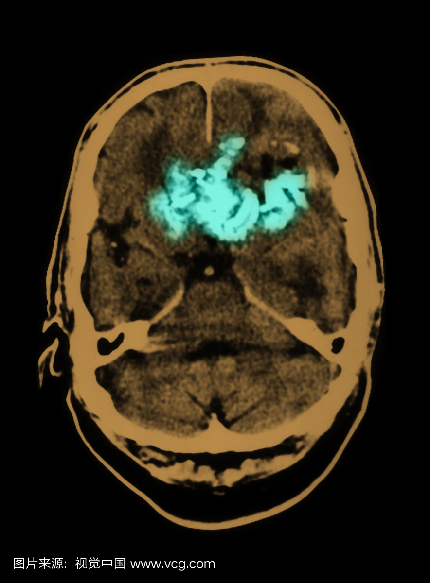 有相关质量效应的大的,显着钙化的异质额叶质