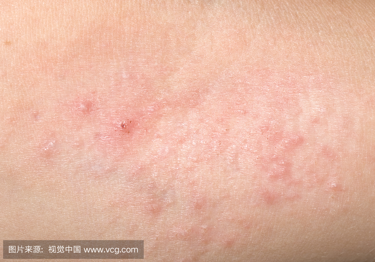 红色皮疹与小孩碰撞,疤痕和丘疹