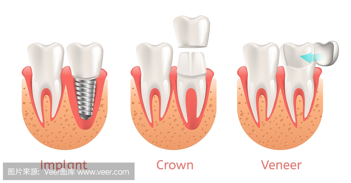 牙齿程序种植牙单板冠恢复