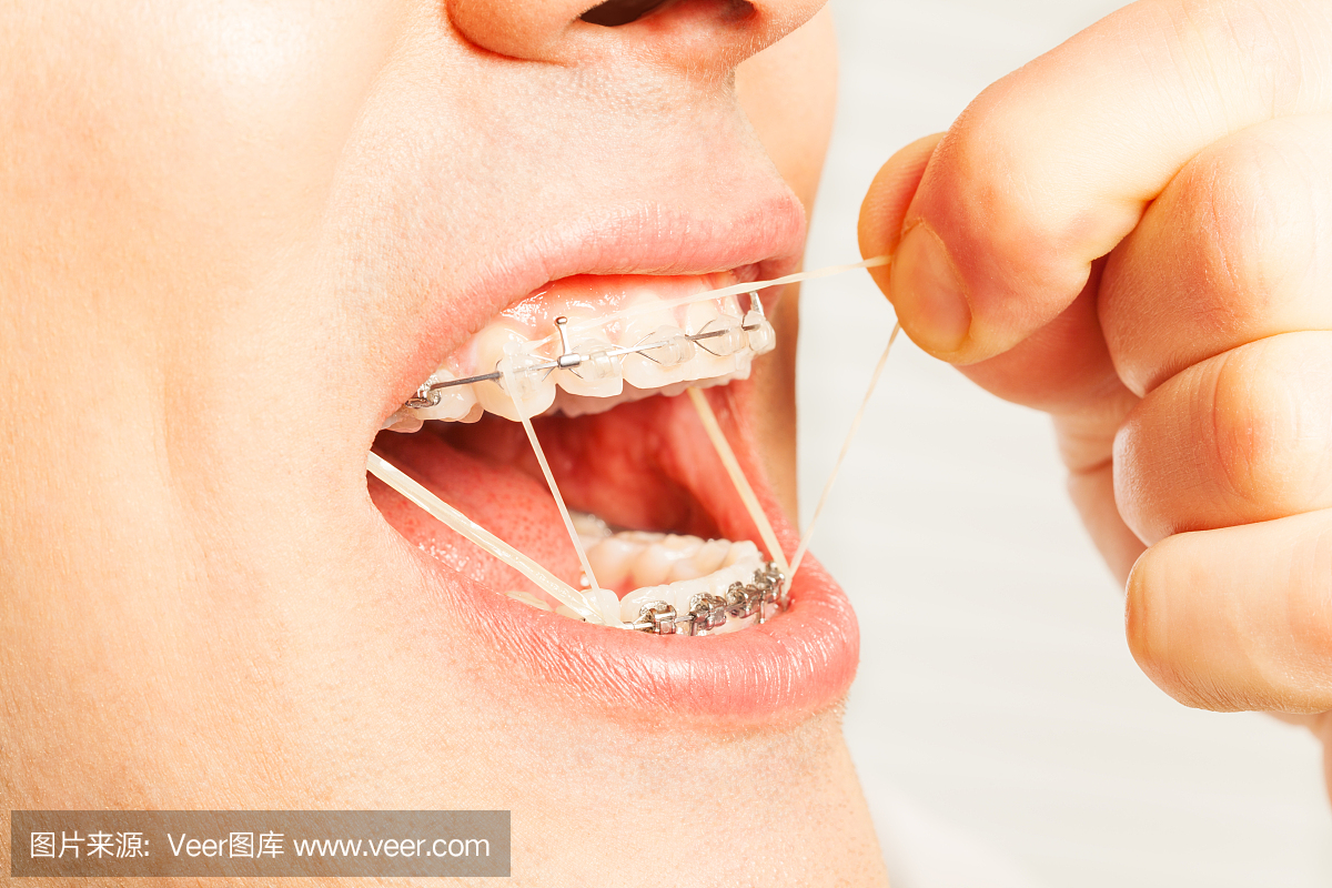 隐形矫治,隐适美,透明牙套,隐形矫正